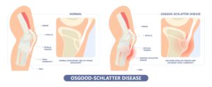 Comparatif genou sain et genou atteint de la maladie Osgood-Schlatter