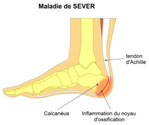 maladie de sever - schéma explicatif - Anthony Carreira