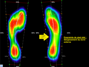 Empreintes de pieds plats -élargissement de l'empreinte à droite - Anthony CARREIRA